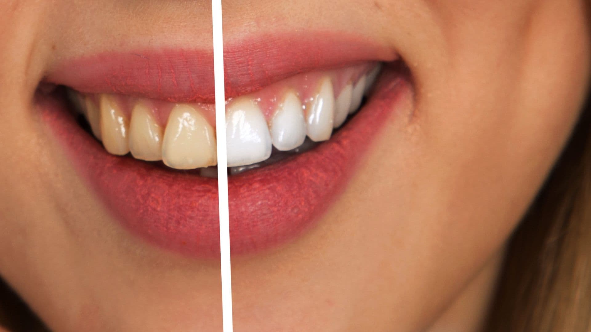 Clareamento dental