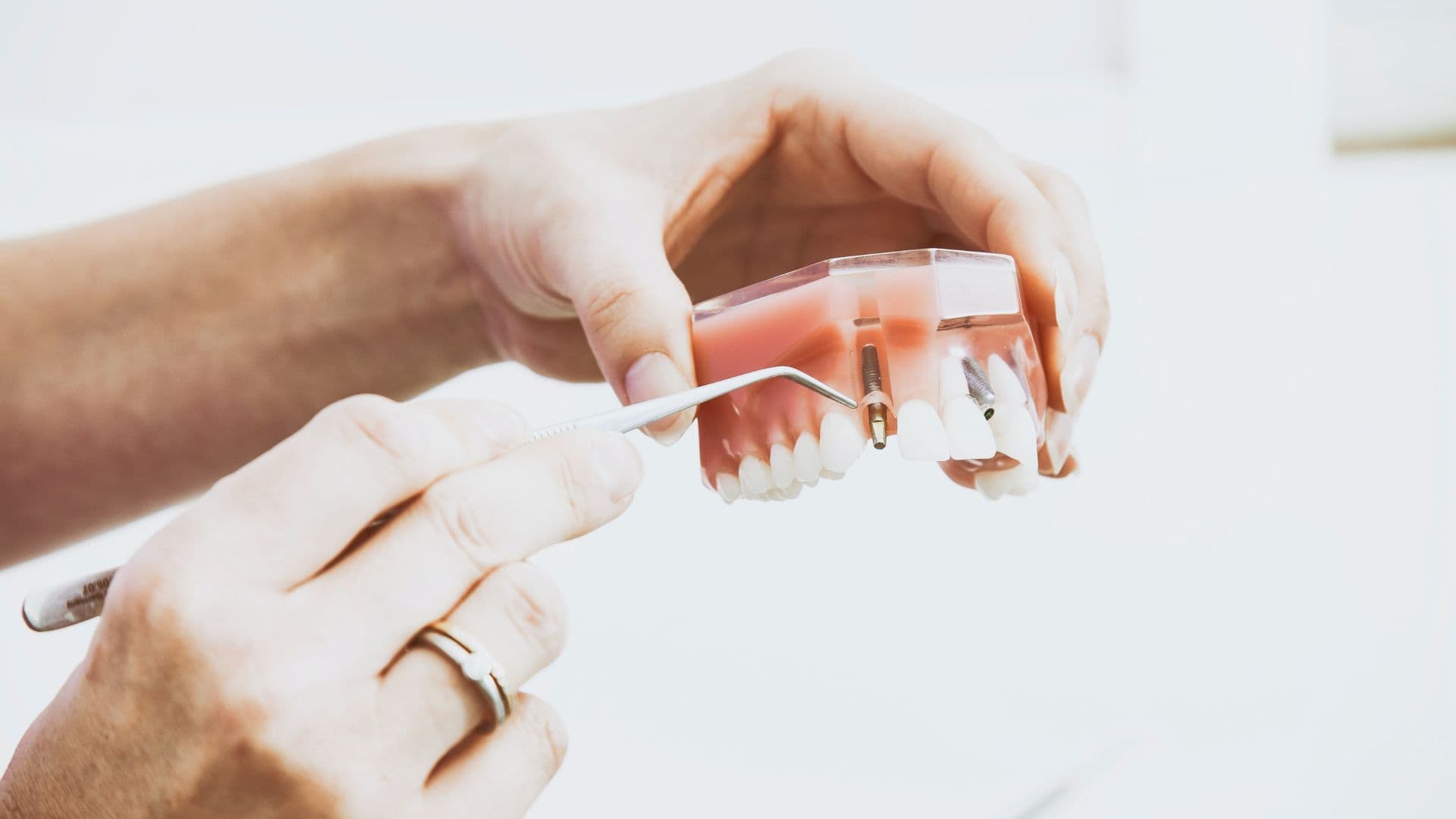 Implantes dentários